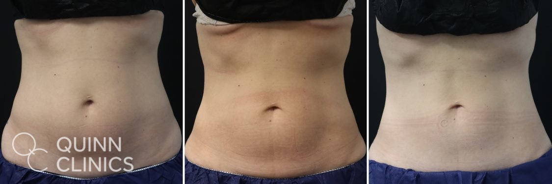 CoolSculpting Love Handles, Coolsculpting flanks before and after